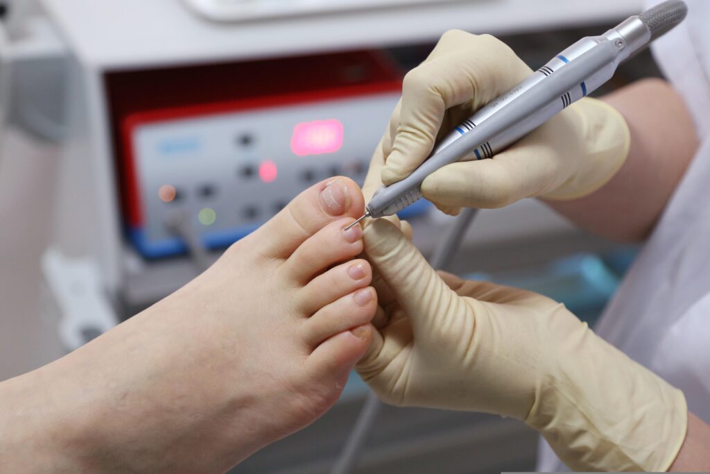 Podiatrist wearing gloves drills a patient's toenail during a foot procedure.