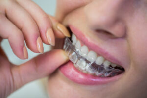Close-up of a person inserting a clear aligner onto their teeth with a finger.